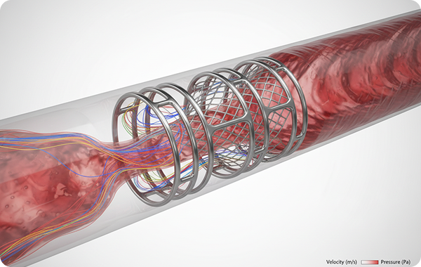 Computational fluid dynamics model of blood flow through a medical device